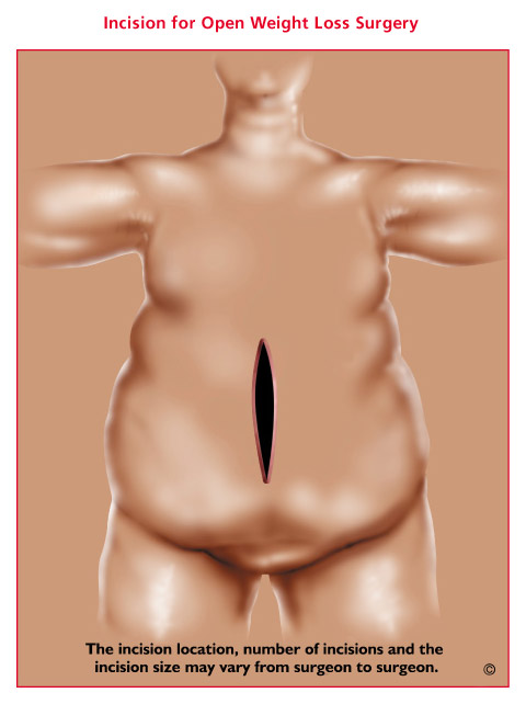 picture of bariatric weight loss surgery